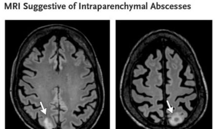 A kidney stone infection evolved in one patient Nad eventually caused a brain abscess