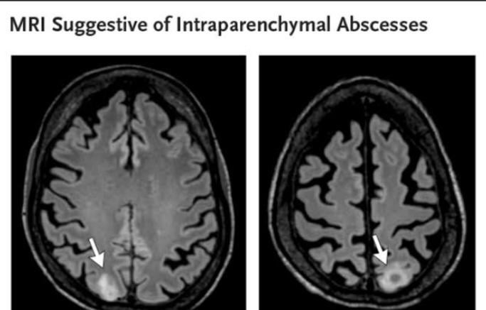 A kidney stone infection evolved in one patient Nad eventually caused a brain abscess