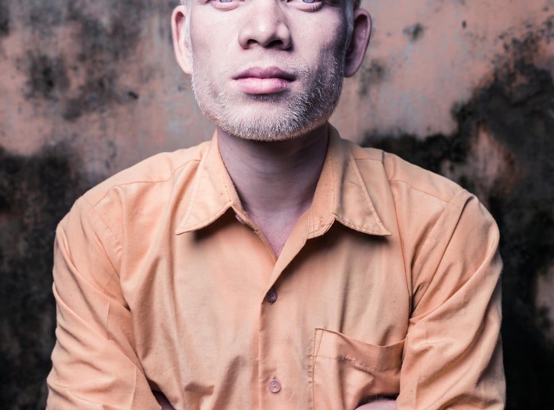 Albinos in India