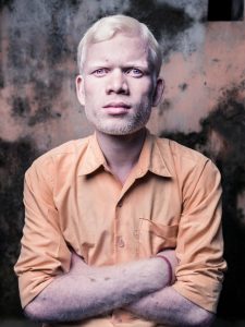 Albinos in India