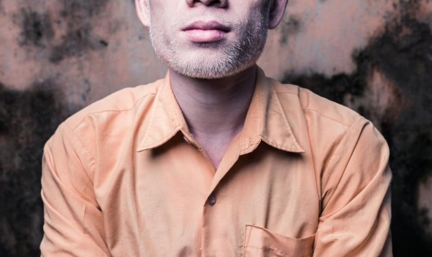 Albinos in India