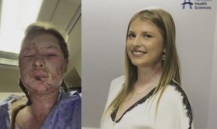 An 18-year-old fully recovers from severe burn scars after world’s first experimental treatment (without skin grafts).
