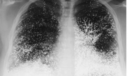 Chest X-Ray of 21 yr old dental assistant after attempting suicide by intravenously injecting elemental mercury
