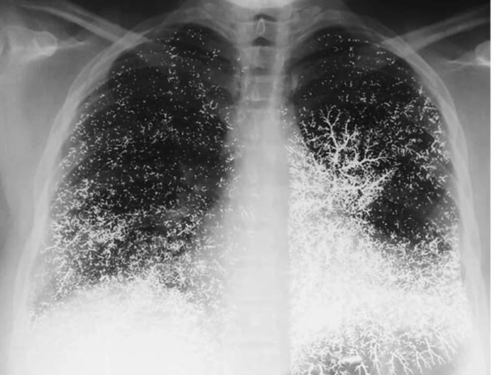 Chest X-Ray of 21 yr old dental assistant after attempting suicide by intravenously injecting elemental mercury