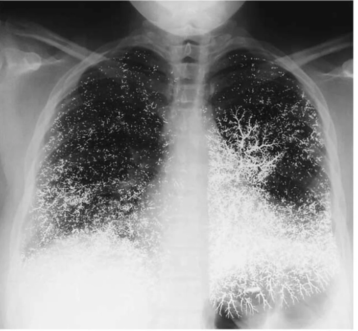 Chest X-Ray of 21 yr old dental assistant after attempting suicide by intravenously injecting elemental mercury
