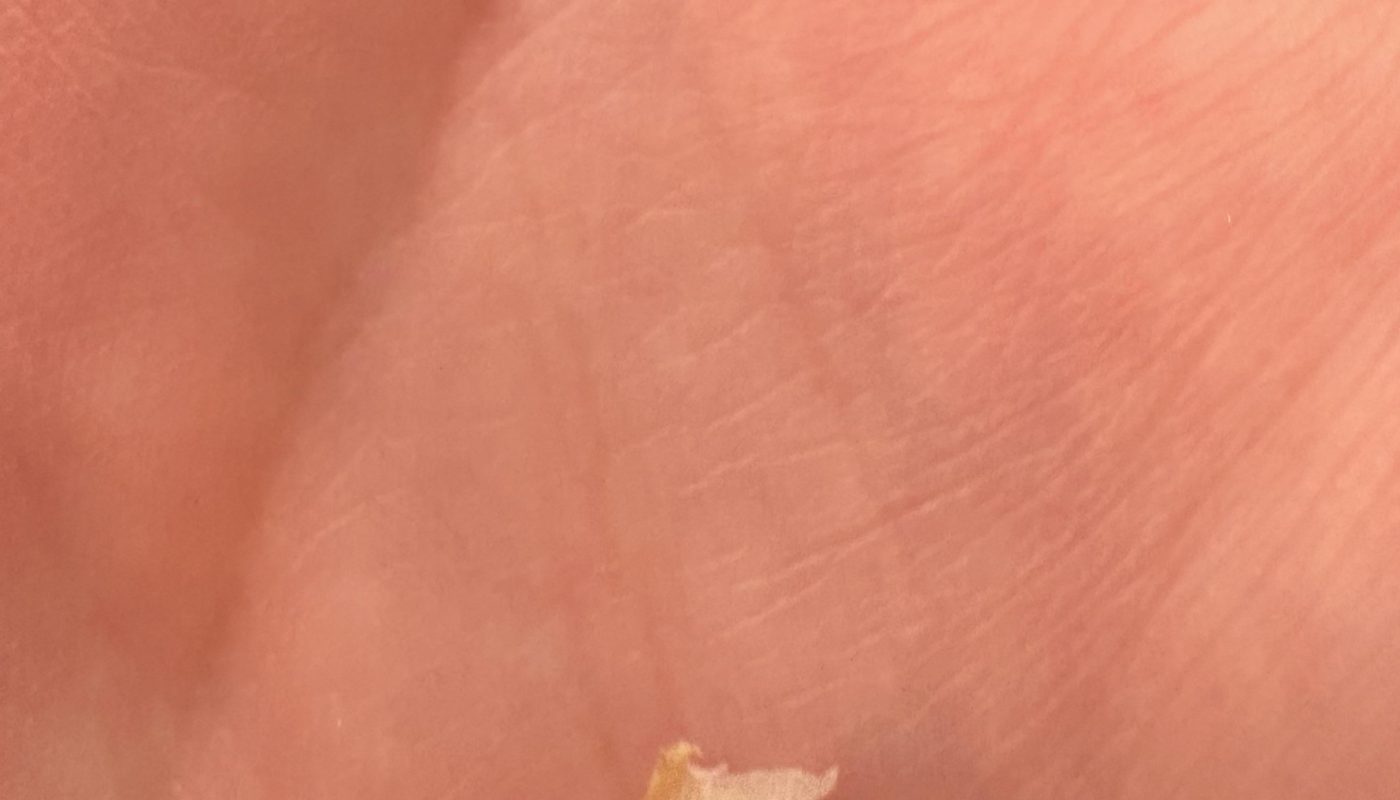 The ingrown toe nail that has been bothering me for 6 months finally removed.
