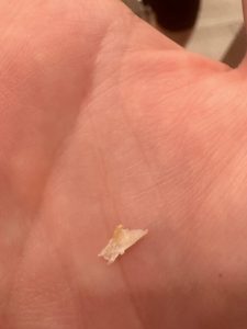 The ingrown toe nail that has been bothering me for 6 months finally removed.