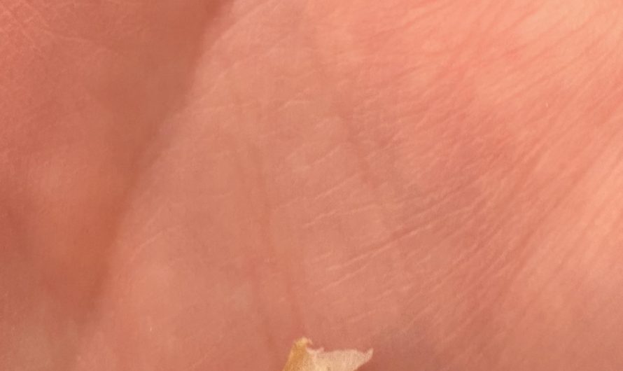 The ingrown toe nail that has been bothering me for 6 months finally removed.