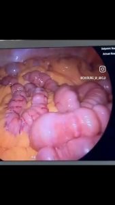 inside of your intestine