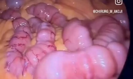 inside of your intestine