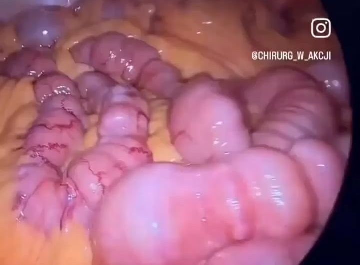 inside of your intestine