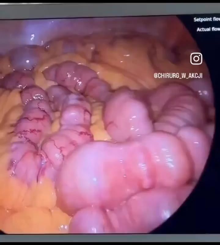 inside of your intestine