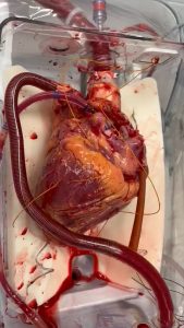 your human heart is awaiting transplant this is how it beats inside our body normally, 24/7