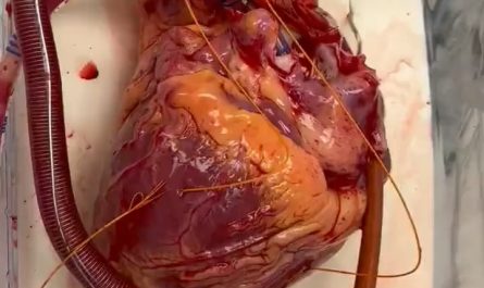 your human heart is awaiting transplant this is how it beats inside our body normally, 24/7