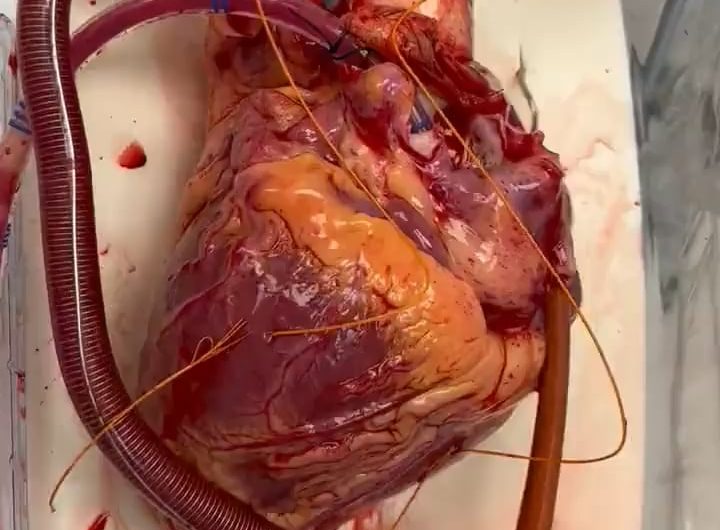 your human heart is awaiting transplant this is how it beats inside our body normally, 24/7