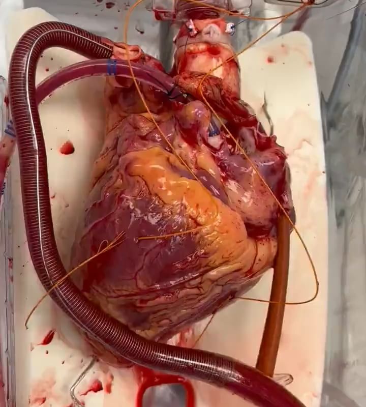 your human heart is awaiting transplant this is how it beats inside our body normally, 24/7