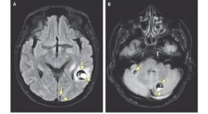 Neurocysticercosis :The Disease which turns parasites into brain cysts