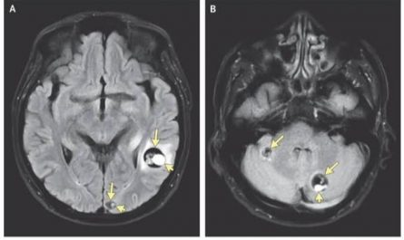 Neurocysticercosis :The Disease which turns parasites into brain cysts
