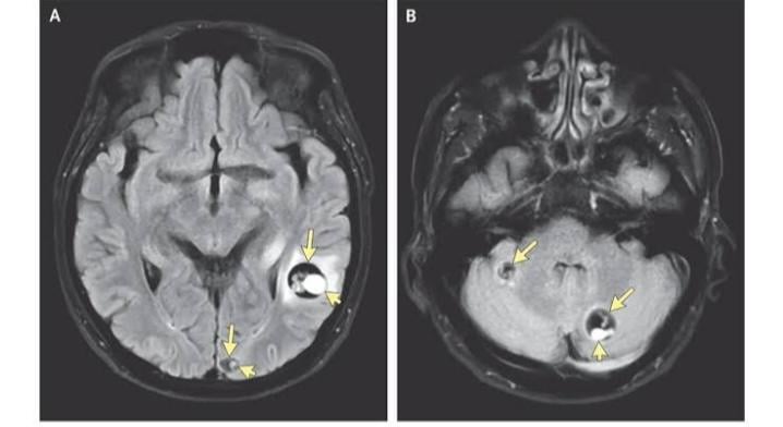 Neurocysticercosis :The Disease which turns parasites into brain cysts